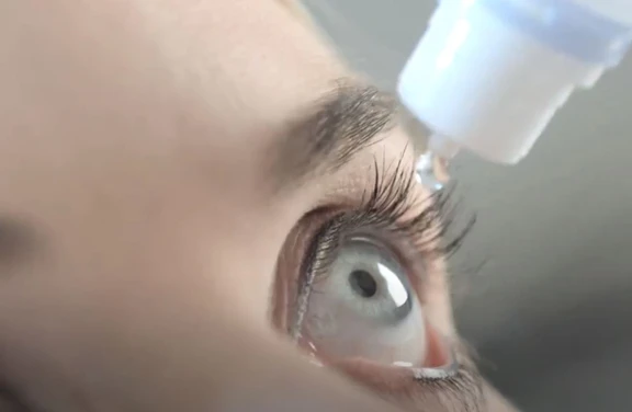 A close-up of a female with light blue eyes receiving an eye drop from Aptar Pharma’s ophthalmic squeeze dispenser. The drop is about to be dispensed near her upper eyelashes, showing the precision of the eye care dropper.